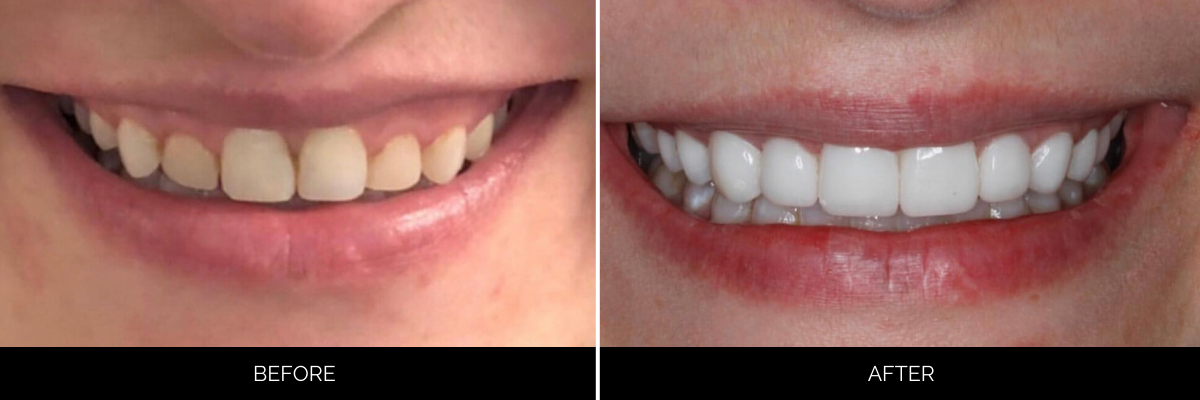 Before and after veneer treatment showing short, stained teeth restored to uniform bright white smile