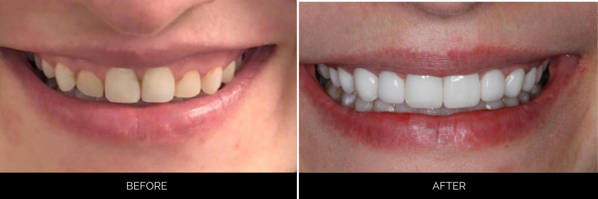 Before and after smile makeover showing yellowed teeth replaced with bright white veneers
