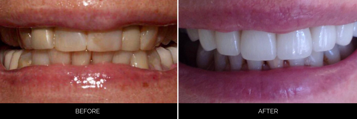 Before and after smile makeover showing discolored, misaligned teeth transformed to bright white veneers