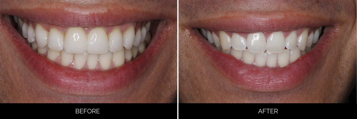 Before and after cosmetic dental treatment showing improved tooth alignment and whiteness