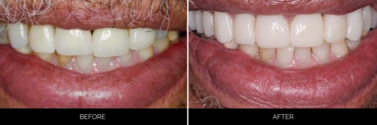 Before and after smile transformation with upper teeth whitened and corrected for shape and alignment
