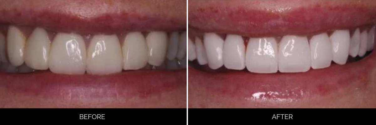 Before and after veneers showing improved tooth shape and brightness