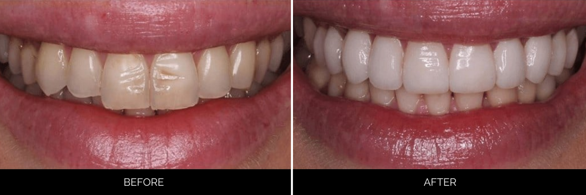 Before and after smile displaying yellowed teeth whitened and reshaped with professional cosmetic dentistry