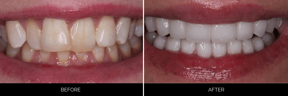 Before and after veneers: crowded lower teeth with discoloration versus aligned, gleaming white smile