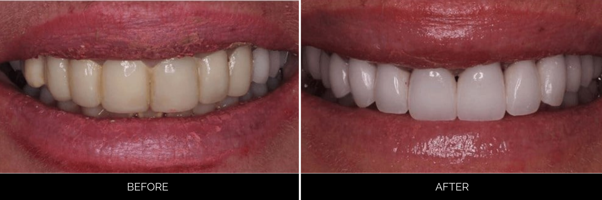 Before and after veneers: stained, irregular teeth versus luminous, evenly proportioned smile