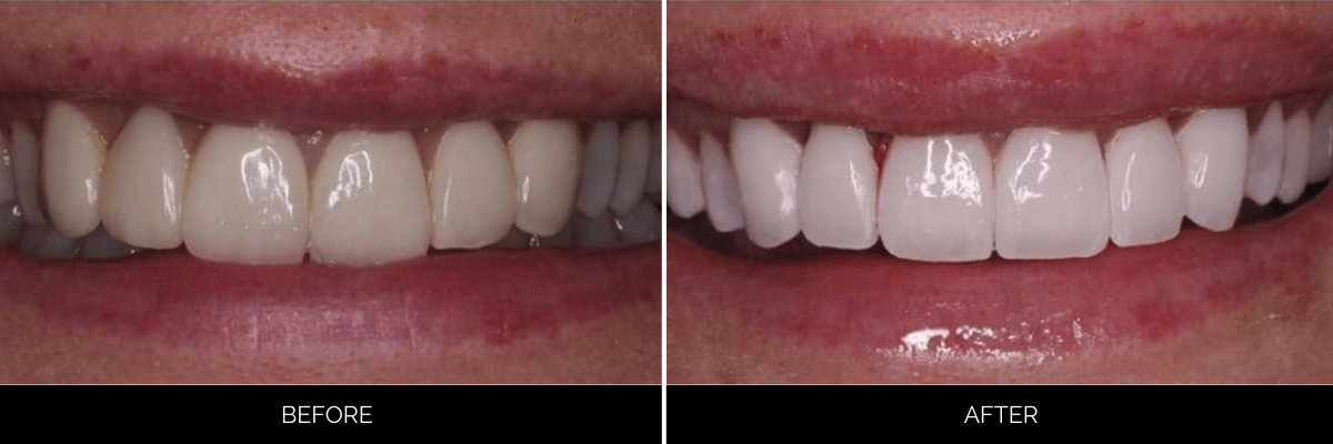 Before and after veneers: worn, misshapen upper teeth versus smooth, symmetrical white smile