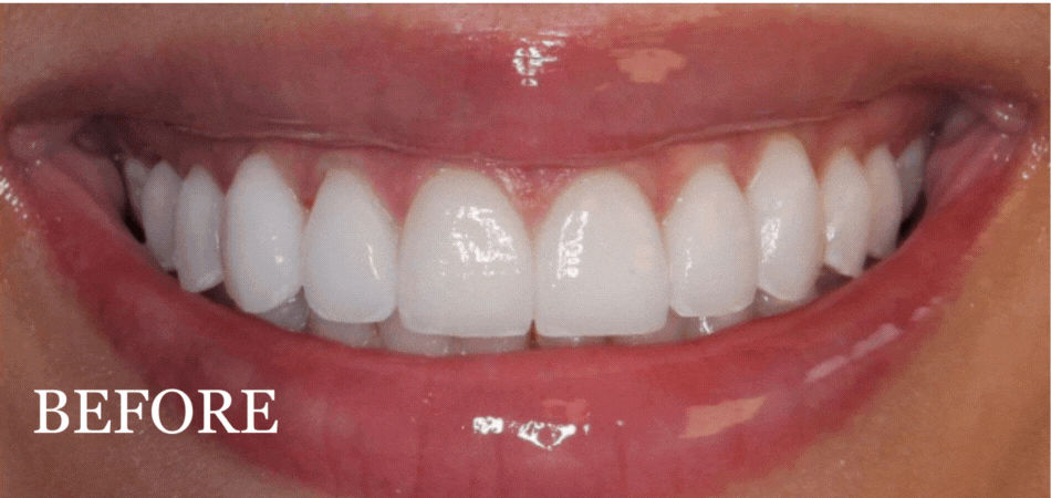 Before image of patient's teeth before cosmetic dental treatment
