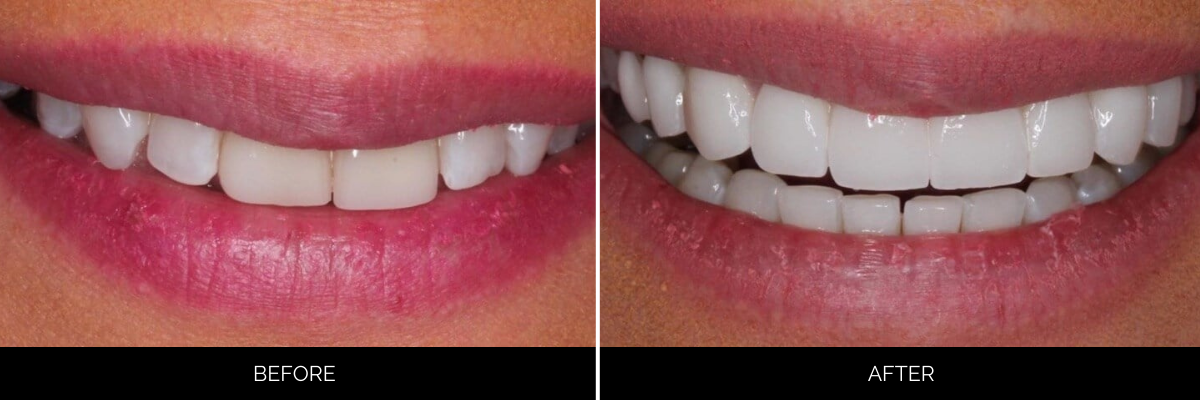 Before and after smile transformation showing improved tooth whiteness and alignment from cosmetic dental treatment