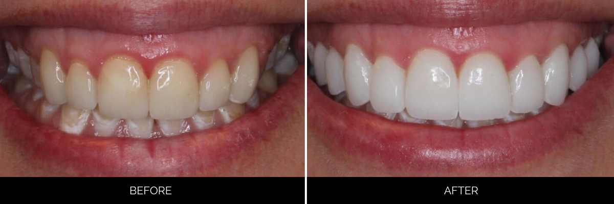 Before and after smile showing discolored teeth transformed to bright white veneers with improved symmetry