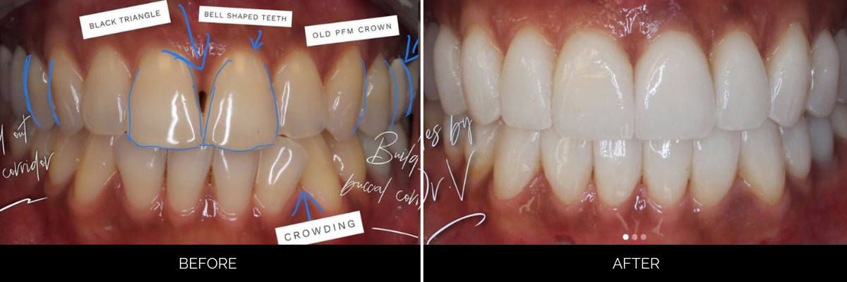 Before and after full smile makeover with annotations showing correction of black triangles, bell-shaped teeth, and crowding to create balanced white veneers