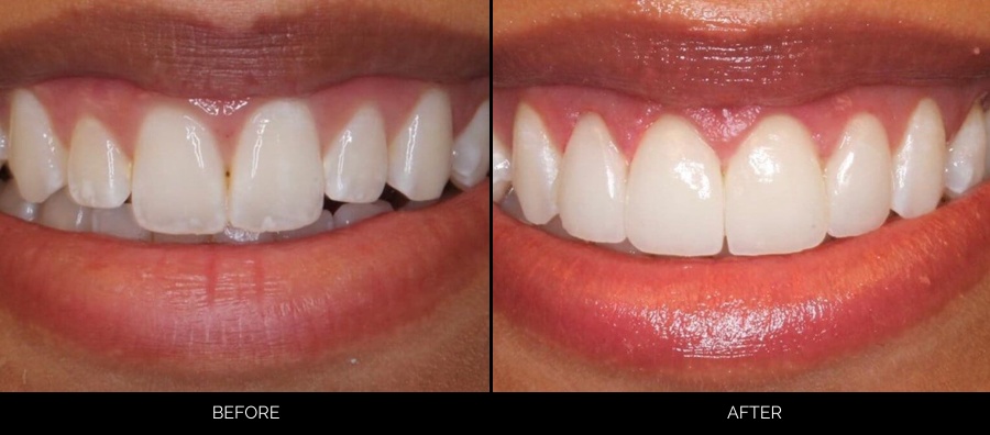 Before and after smile showing whitened, evenly spaced teeth from cosmetic dental treatment