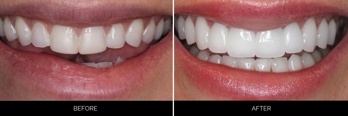 Before and after veneer case showing worn, stained teeth restored to a pristine white smile