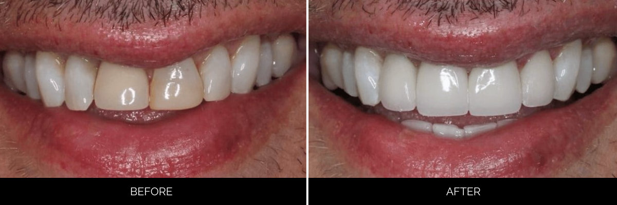 Before and after smile comparison with chipped front teeth restored to uniform bright white veneers