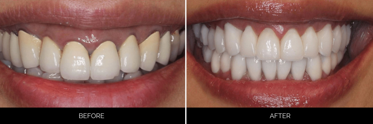 Before and after smile showing discolored and uneven teeth corrected with bright white cosmetic veneers