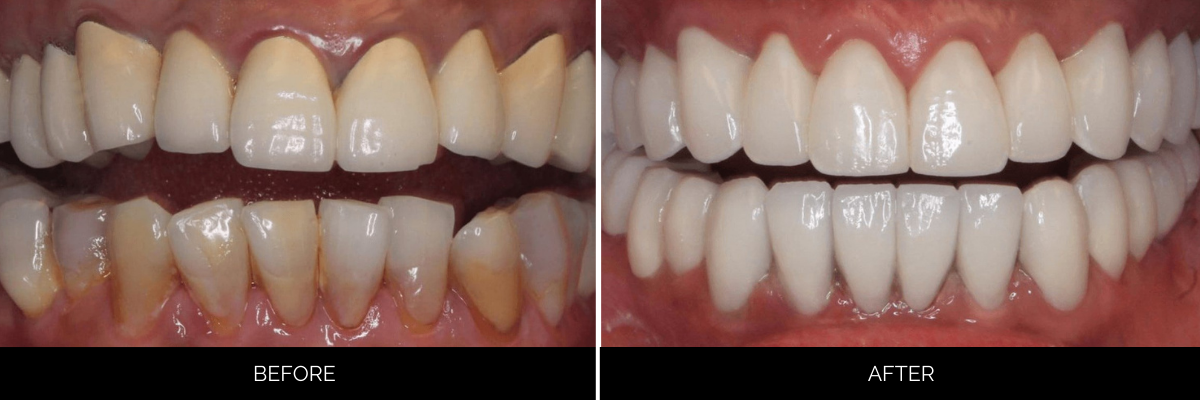 Before and after cosmetic dental veneers: discolored, uneven teeth transformed to bright, uniform white smile
