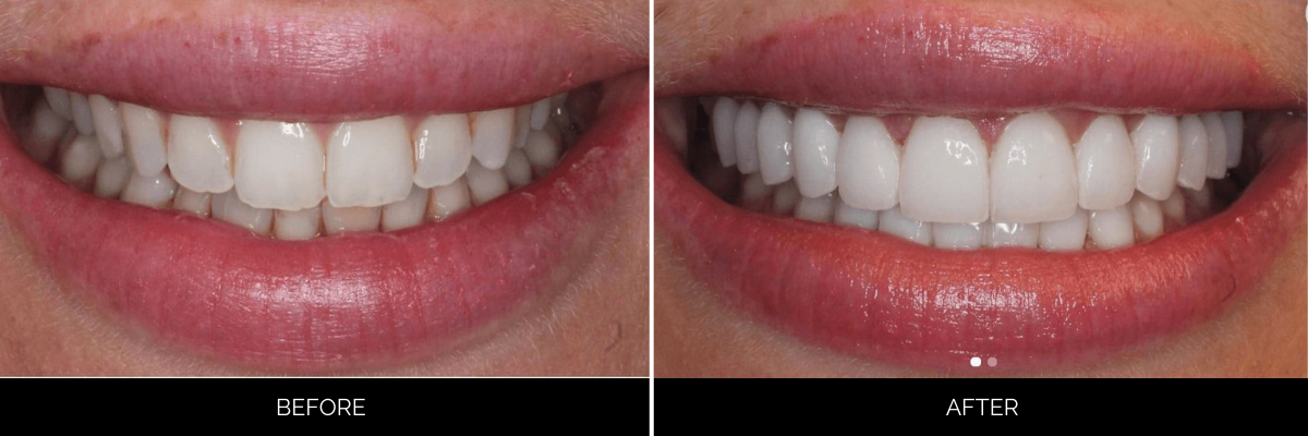 Before and after smile revealing dull, uneven teeth brightened and perfected with cosmetic dental work