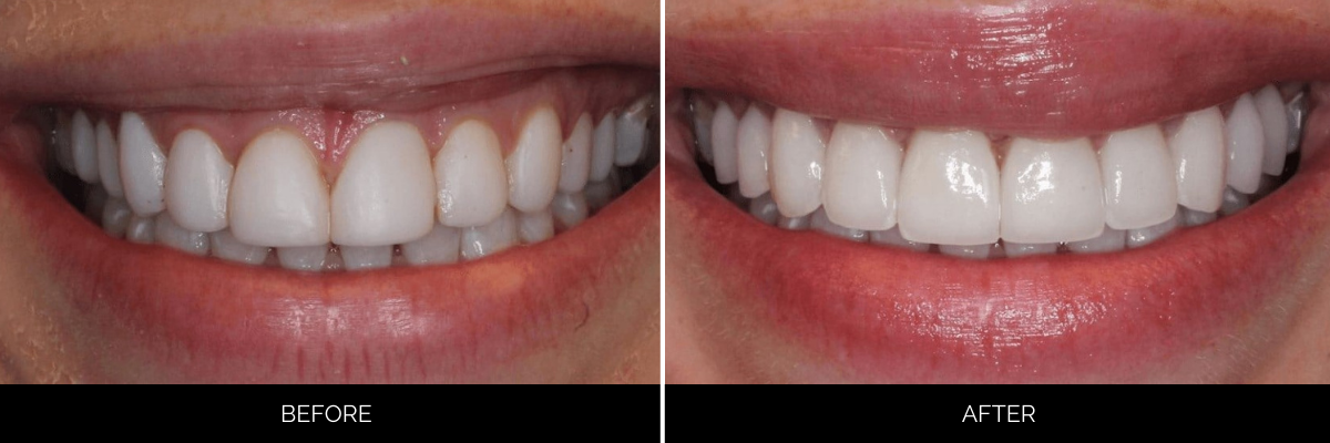 Before and after smile makeover: yellowed front teeth with gaps corrected to aligned, whitened smile