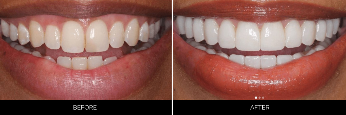 Before and after cosmetic dentistry: uneven, discolored teeth brightened and shaped for symmetrical smile