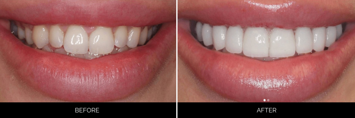Before and after dental bonding: chipped, stained front tooth restored to natural, seamless appearance