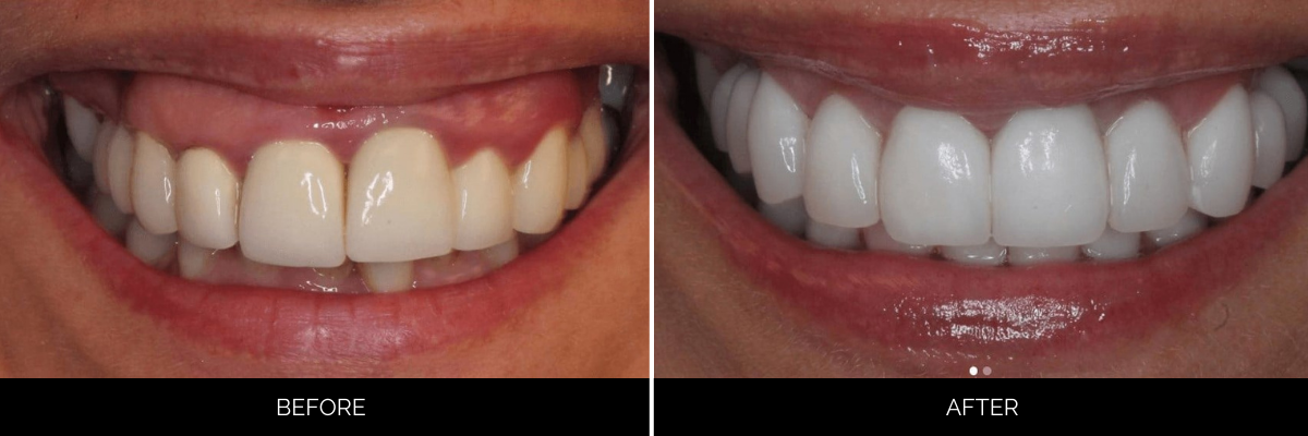Before and after veneers: aged, yellowed smile rejuvenated with bright, evenly shaped teeth