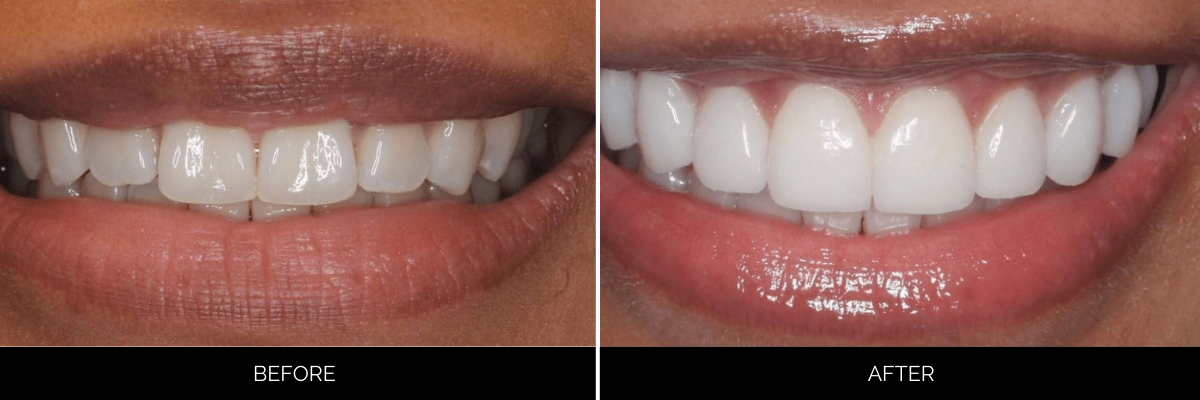 Before and after smile makeover showing whiter, more aligned teeth with veneers
