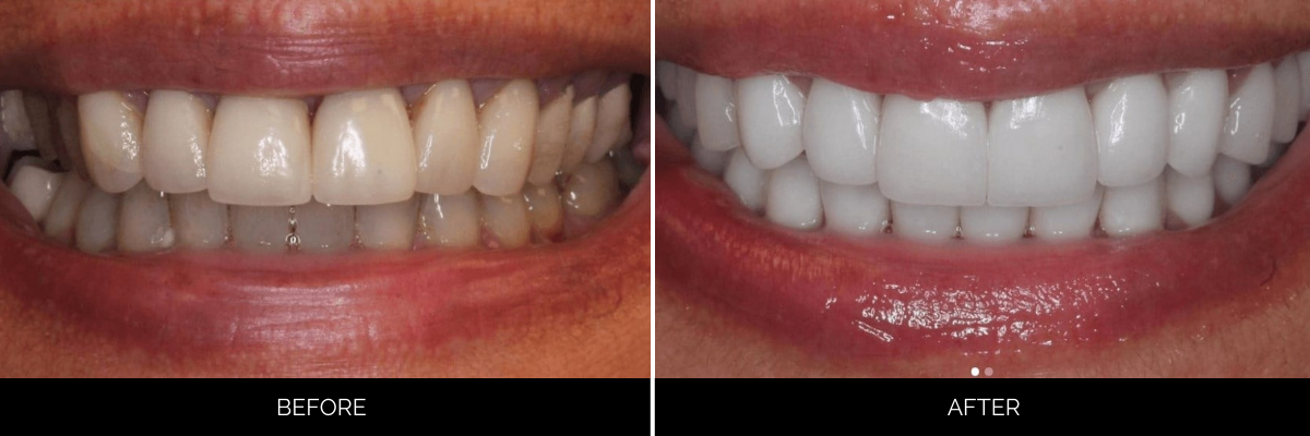 Before and after cosmetic dental treatment showing yellowed teeth transformed to bright white smile