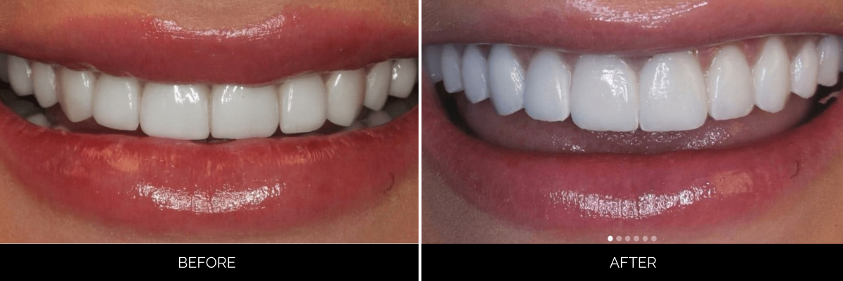 Before and after veneers showing discolored teeth replaced with luminous white smile