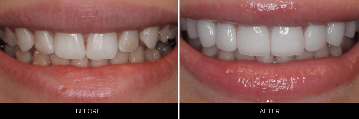 Before and after smile transformation with tooth-colored restorations creating uniform white teeth