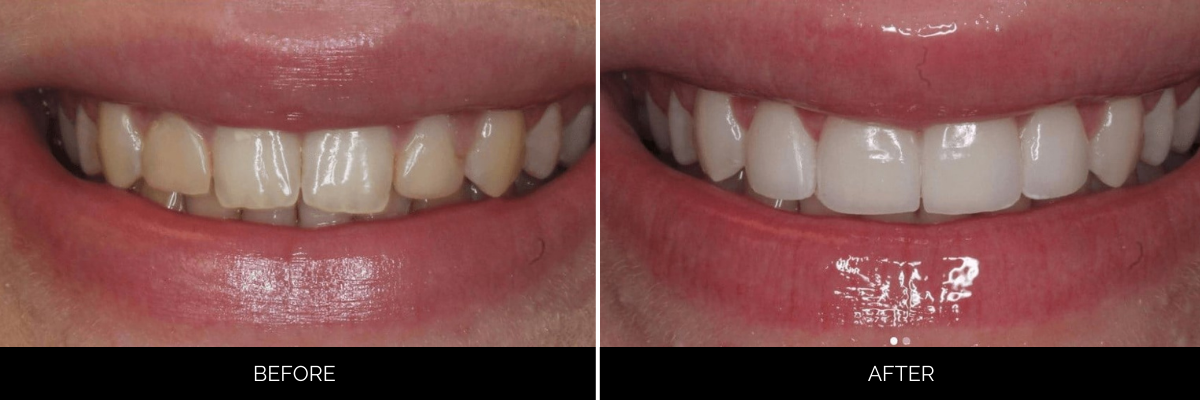 Before and after cosmetic dentistry showing aged, yellowed teeth restored to bright white veneers