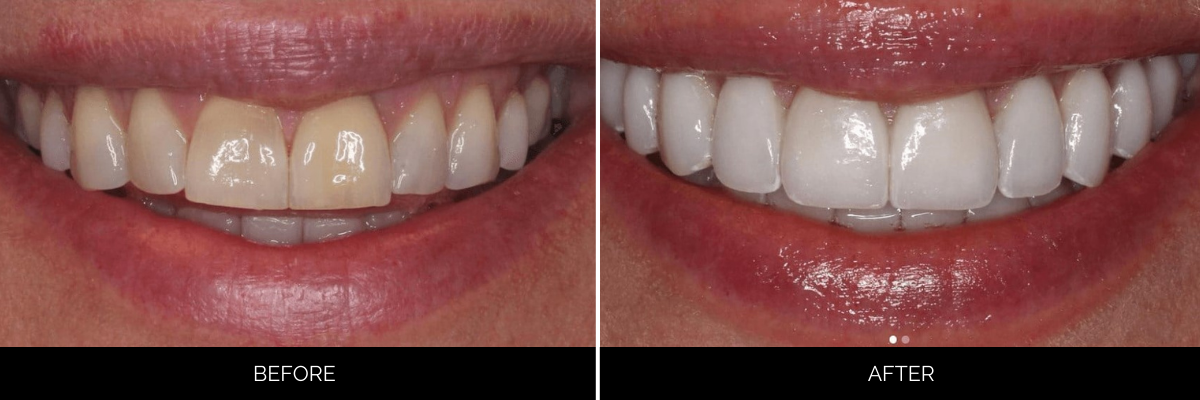 Before and after veneers revealing naturally stained teeth transformed to radiant white smile