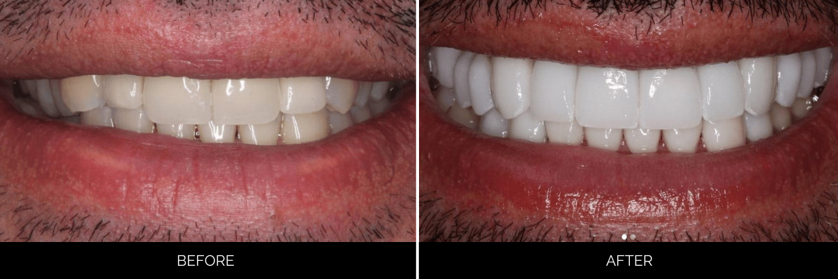 Before and after cosmetic dental treatment showing improved tooth whiteness and alignment