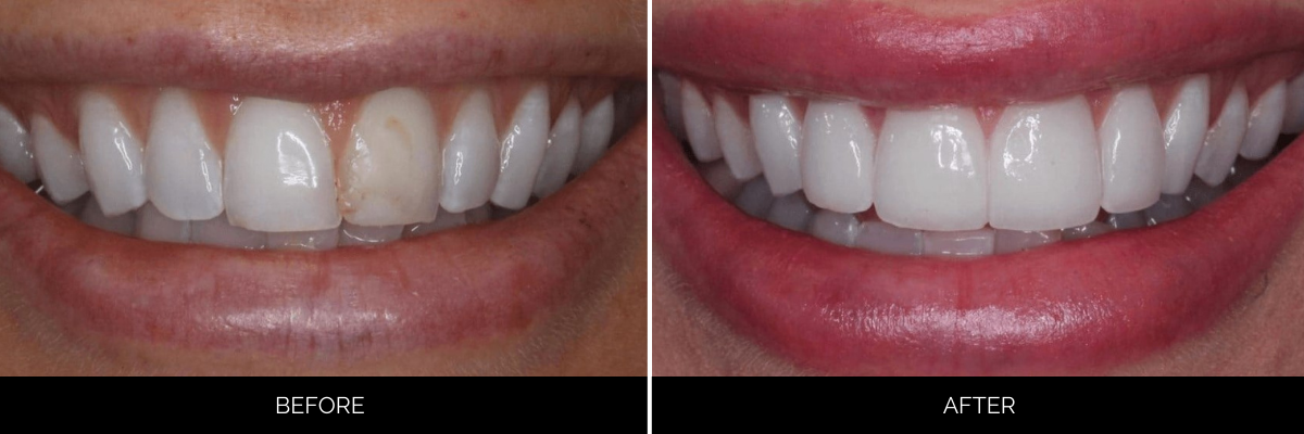 Before and after veneers transformation with brighter, more uniform tooth appearance