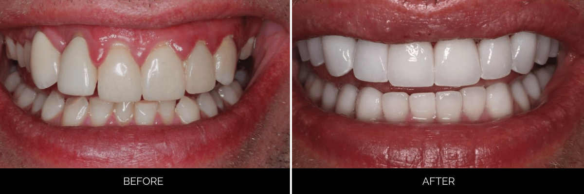 Before and after smile makeover with enhanced tooth shape and whiteness