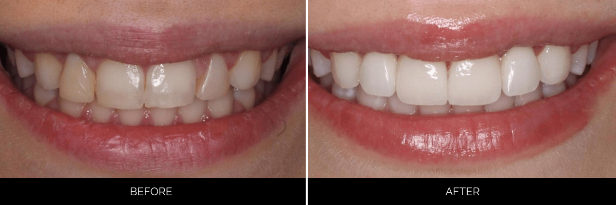 Before and after cosmetic dentistry case with whiter, more evenly spaced teeth