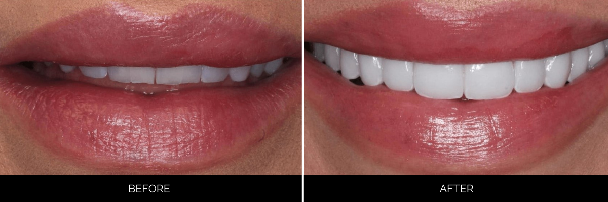 Before and after teeth whitening and cosmetic restoration results