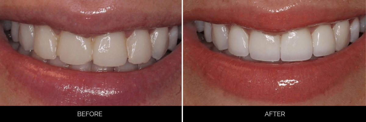 Before and after full smile enhancement with improved tooth color and form