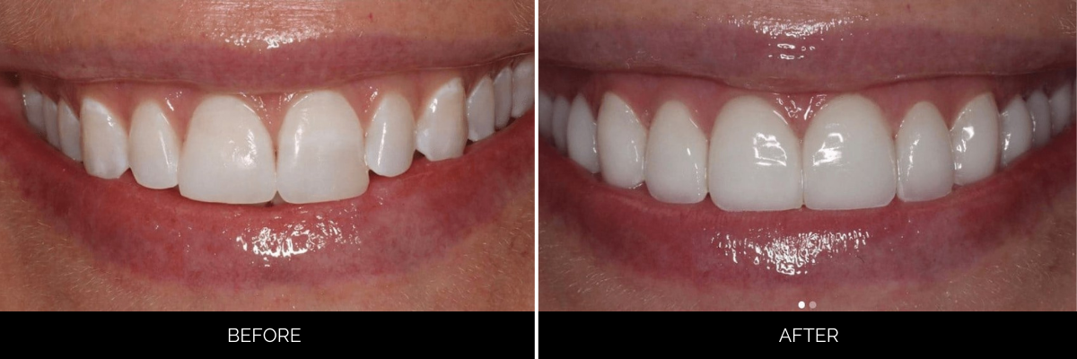 Before and after smile makeover showing improved tooth alignment and whiteness