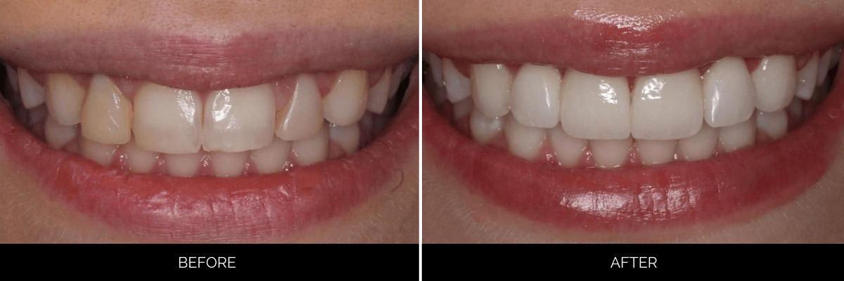 Before and after veneers transformation with brighter, more uniform front teeth