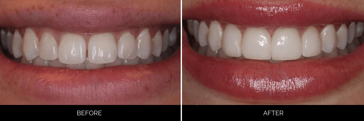 Before and after cosmetic dentistry showing corrected tooth shape and color