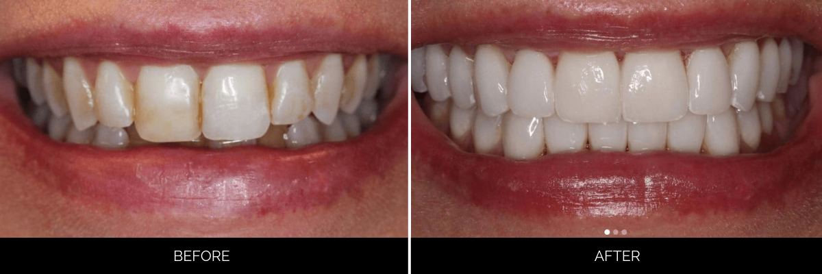 Before and after smile design with whitened and reshaped front teeth