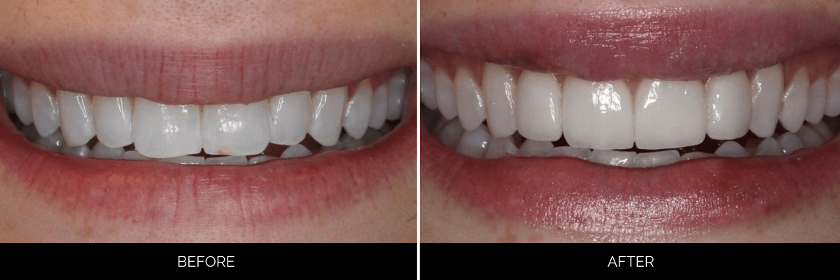 Before and after dental veneers creating a brighter, more symmetrical smile