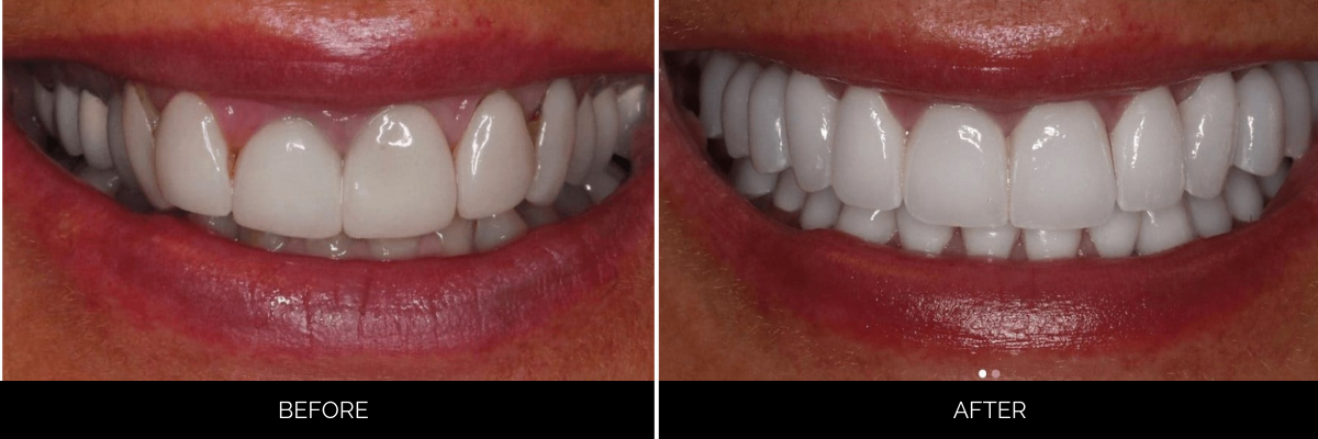Before and after full smile restoration with whitened and aligned teeth