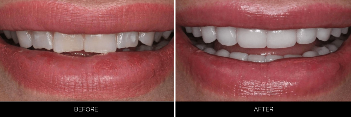 Before and after smile showing discolored, uneven teeth transformed to bright, uniformly aligned teeth