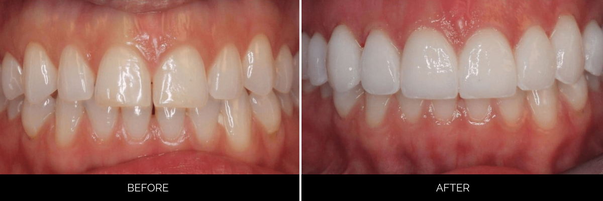 Before and after upper teeth showing yellowed, worn teeth corrected to bright white veneers