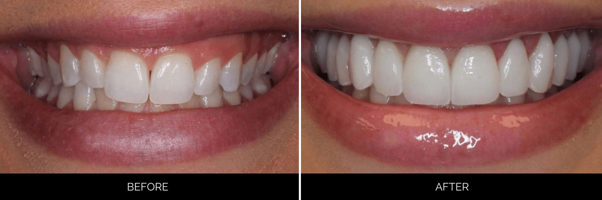 Before and after smile displaying chipped, uneven teeth restored to smooth, bright white veneers