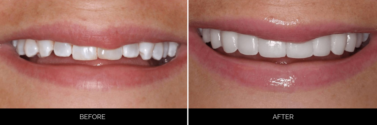 Before and after teeth showing worn, discolored upper teeth transformed to bright white, symmetrical veneers