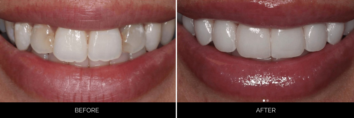 Before and after smile with uneven, stained teeth corrected to uniformly bright white veneers
