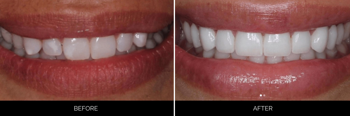 Before and after upper teeth showing yellowed, irregular teeth restored to bright, evenly aligned white veneers