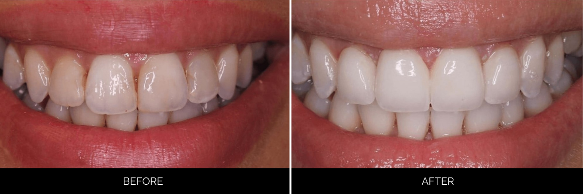 Before and after veneers showing worn, yellowed teeth restored to bright, evenly shaped teeth