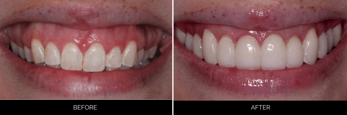 Before and after smile makeover showing crowded, uneven teeth corrected to aligned, bright teeth